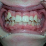3_Before_Teeth